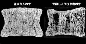 オステオペニア(骨粗鬆症)を防ぐには?
